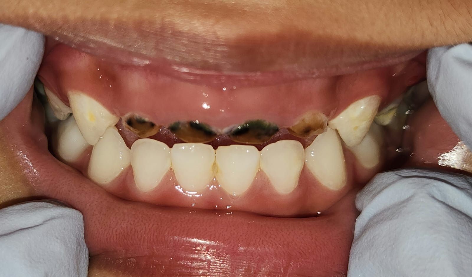 Image of a child's teeth with the top four teeth blackened